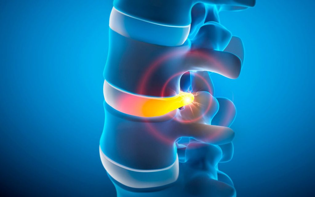 Anatomical illustration of a spinal disc and nearby nerve