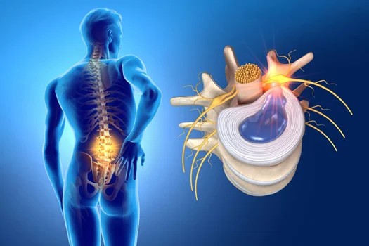 Anatomical illustration of a lumbar disc injury