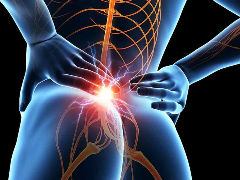 Sciatica