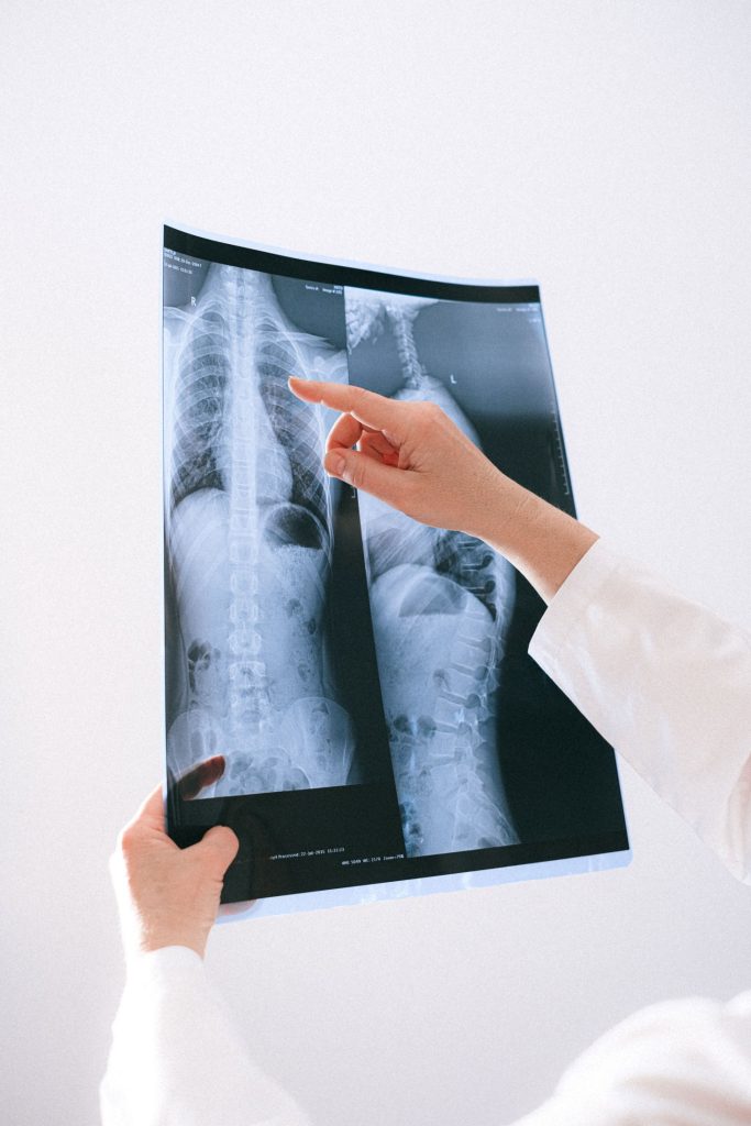 Clinician reviewing a spine X-ray for scoliosis care