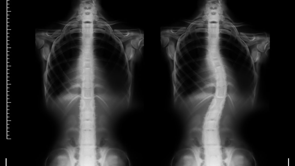 Spinal X-ray used during a scoliosis evaluation