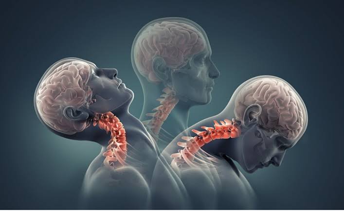 Anatomical illustration showing rapid neck movement in whiplash